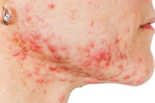 Pimple Treatment